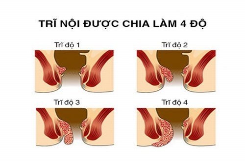 Bệnh trĩ nội là gì? dấu hiệu và biến chứng nguy hiểm