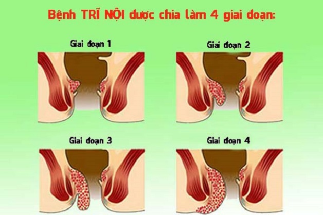 Bệnh trĩ nội và cách điều trị: Những điều cần biết