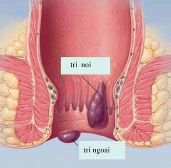 Bệnh trĩ nội và trĩ ngoại khác nhau như thế nào?