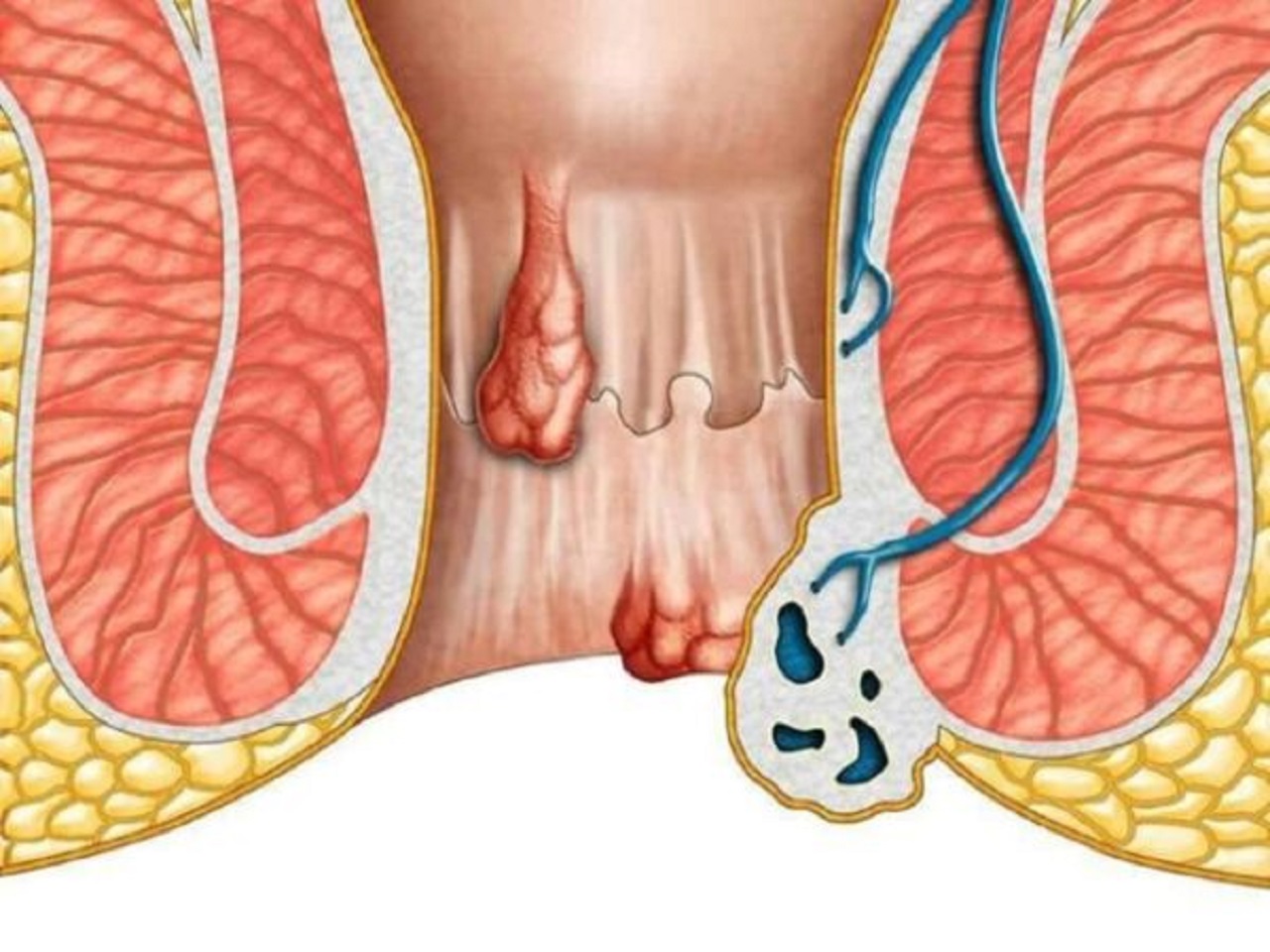 Bệnh trĩ ở phụ nữ: Những điều cần biết