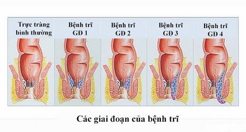 Bệnh trĩ sau phẫu thuật và kiêng kỵ