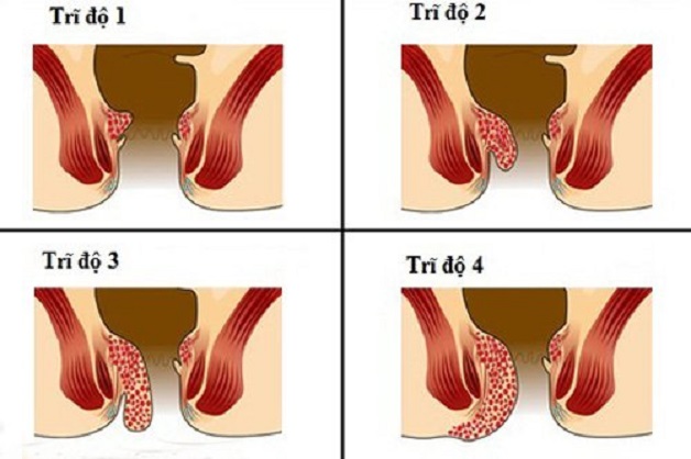 Bệnh trĩ triệu chứng như thế nào?