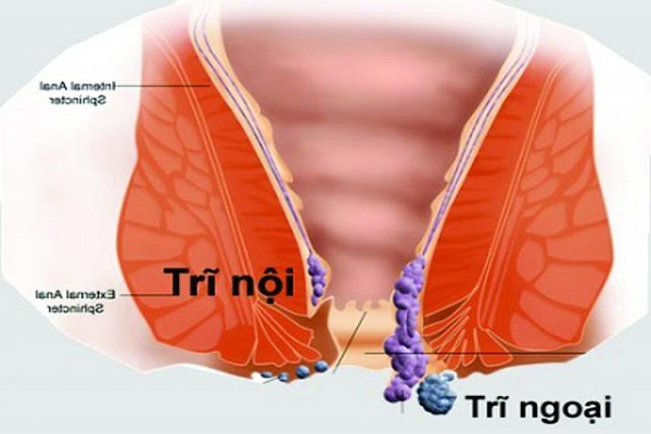 Bệnh trĩ và cách điều trị bạn cần biết