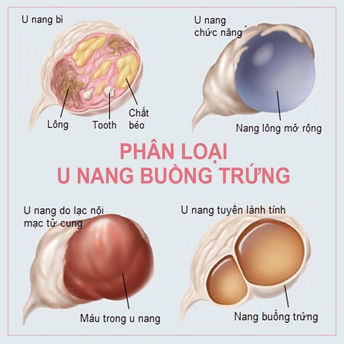 Bệnh u nang buồng trứng có nguy hiểm không?