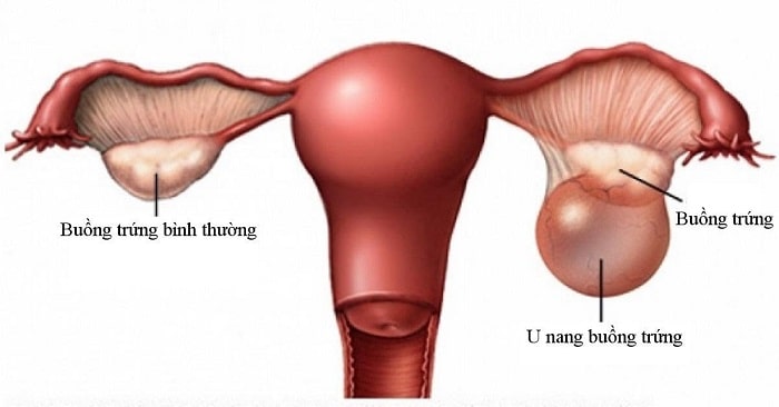 Bệnh u nang buồng trứng và cách điều trị