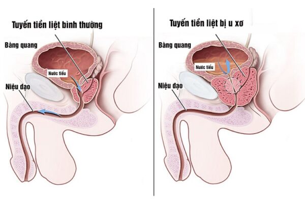 Bệnh u xơ tuyến tiền liệt có nguy hiểm?