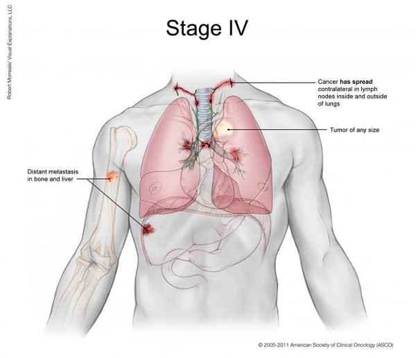Bệnh ung thư có mấy giai đoạn?
