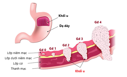 Bệnh ung thư dạ dày giai đoạn 2