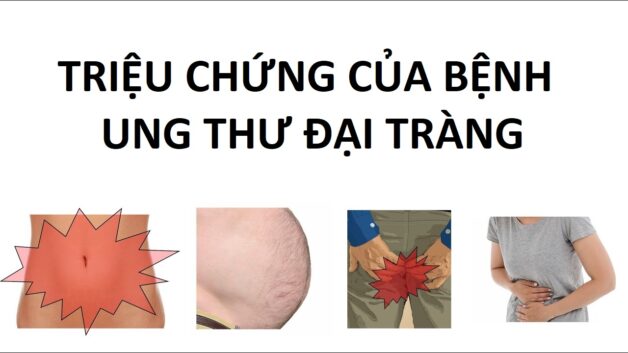 Bệnh ung thư đại tràng: Những thông tin cần biết