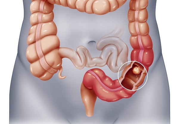 Bệnh ung thư đại trực tràng có nguy hiểm không?