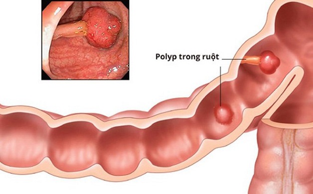 Bệnh ung thư đại trực tràng có nguy hiểm không?