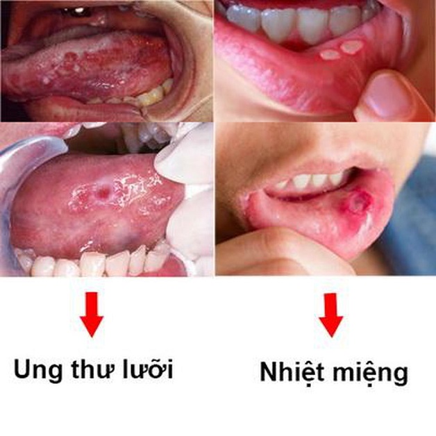 Bệnh ung thư khoang miệng có chữa được không?