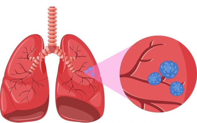 Bệnh ung thư phổi giai đoạn cuối sống được bao lâu?