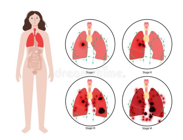 Bệnh ung thư phổi giai đoạn cuối sống được bao lâu?