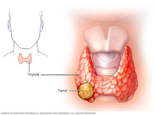 Bệnh ung thư tuyến giáp có chữa được không