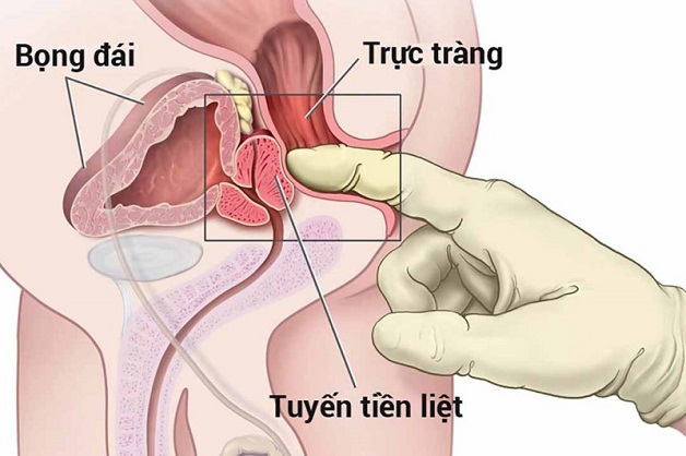 Bệnh ung thư tuyến tiền liệt có chữa được không?