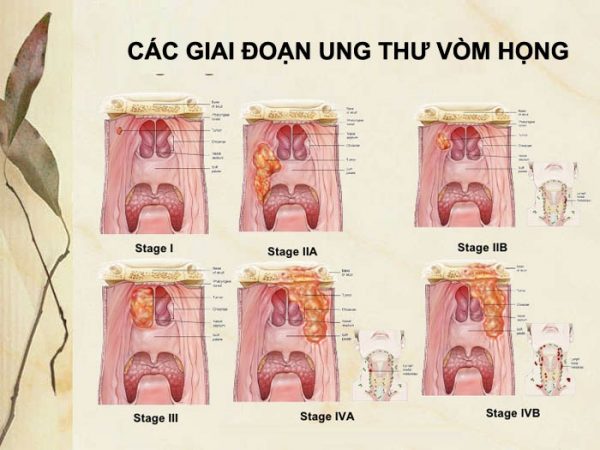 Bệnh ung thư vòm họng sống được bao lâu?cần nên làm gi trước