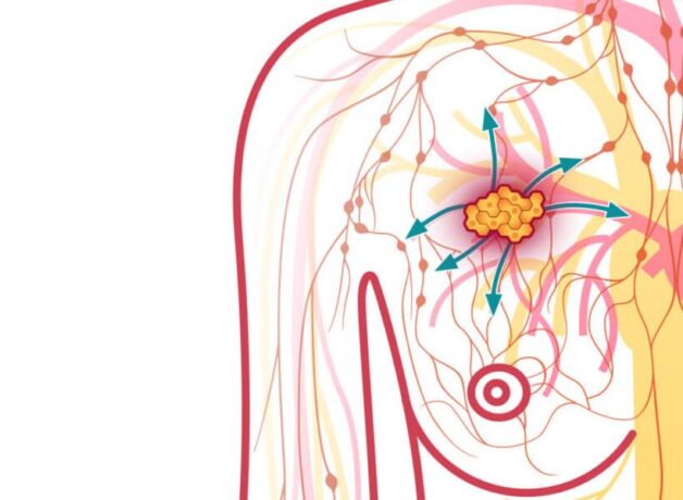 Bệnh ung thư vú giai đoạn cuối chữa thế nào?