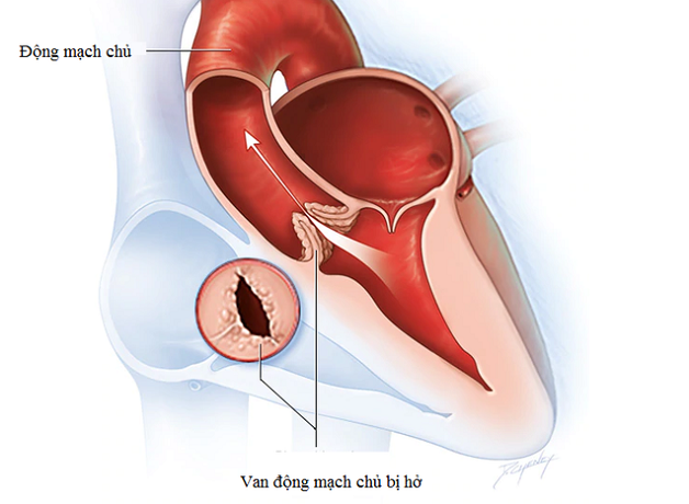 Bệnh van động mạch chủ là gì? Nguyên nhân và dấu hiệu