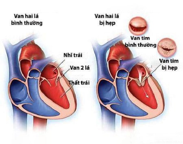 Bệnh van tim hậu thấp: Nguyên nhân, triệu chứng, điều trị 