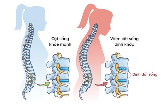 Bệnh viêm cột sống dính khớp kiêng ăn gì và gợi ý từ chuyên gia