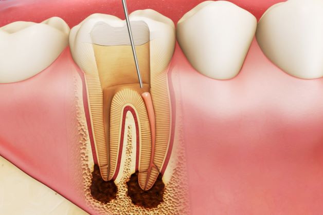 Bệnh viêm cuống răng: nguyên nhân và dấu hiệu nhận biết