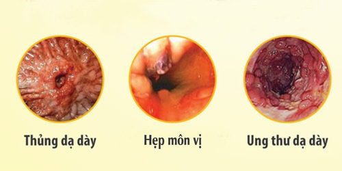 Bệnh viêm dạ dày cấp tính có nguy hiểm không?