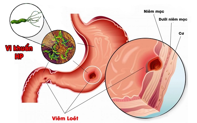 Bệnh viêm dạ dày mãn tính: Nguyên nhân, triệu chứng và phòng ngừa