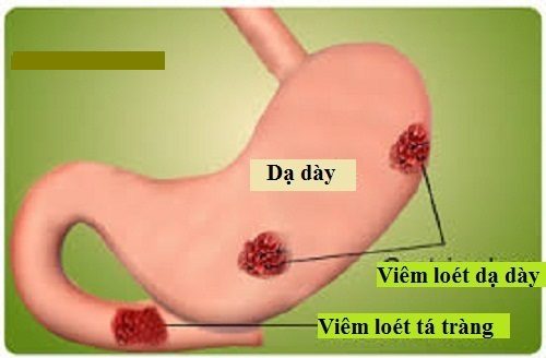 Bệnh viêm dạ dày tá tràng là gì?