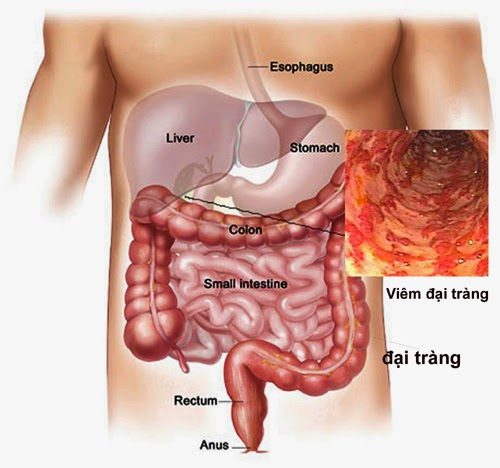 Bệnh viêm dạ dày trào ngược