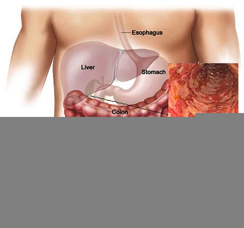 Bệnh viêm đại tràng chữa khỏi được không?