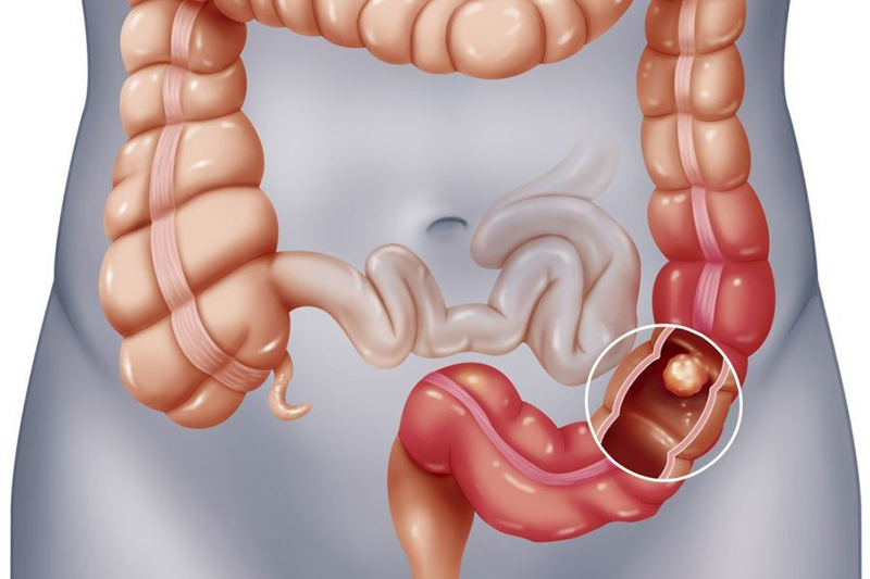 Bệnh viêm đại tràng: Nhận biết sớm – Điều trị ngay