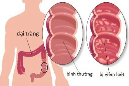 Bệnh viêm đại tràng và những điều cần biết