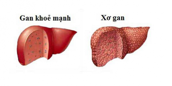 Bệnh viêm gan B có nguy hiểm không, biểu hiện thế nào?