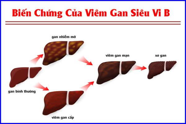 Bệnh viêm gan B ở trẻ em có nguy hiểm không?