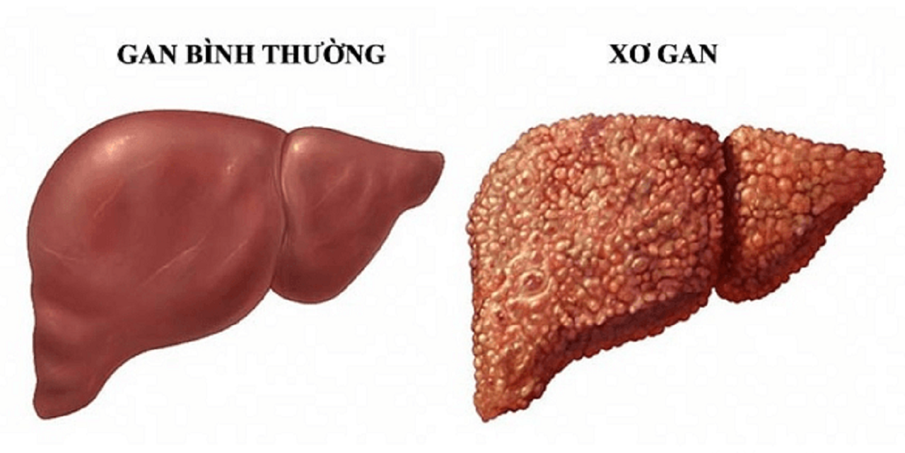 Bệnh viêm gan C: Kẻ hủy diệt thầm lặng tuyệt đối không thể chủ quan