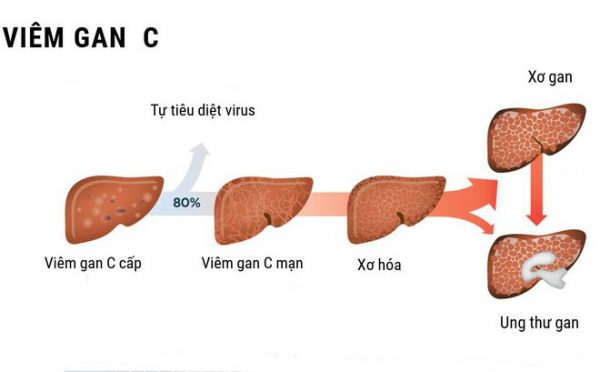 Bệnh viêm gan C: Kẻ hủy diệt thầm lặng tuyệt đối không thể chủ quan