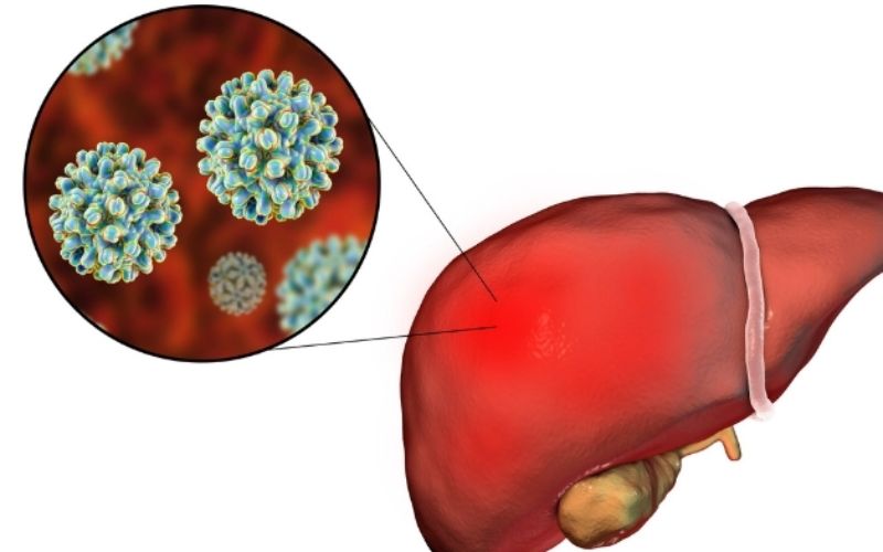 Bệnh viêm gan cấp tính là gì? nguyên nhân và cách điều trị