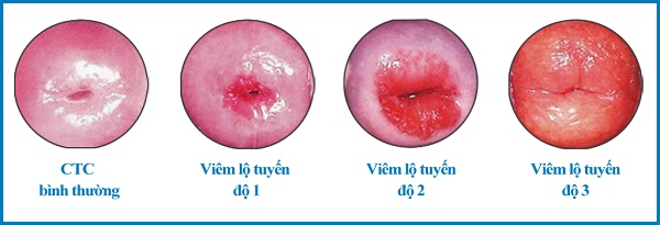 Bệnh viêm lộ tuyến cổ tử cung là gì?