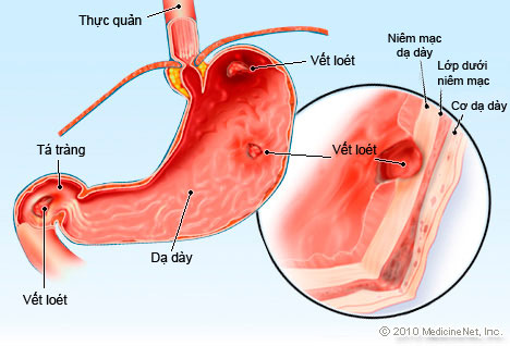 Bệnh viêm loét dạ dày có lây qua ăn uống không?