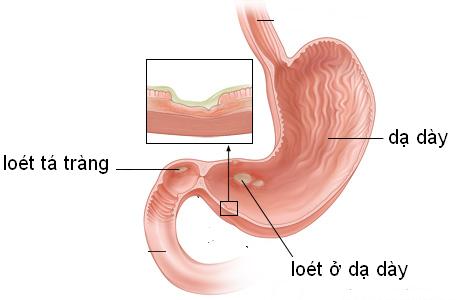 Bệnh viêm loét dạ dày