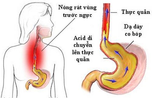 Bệnh viêm loét thực quản