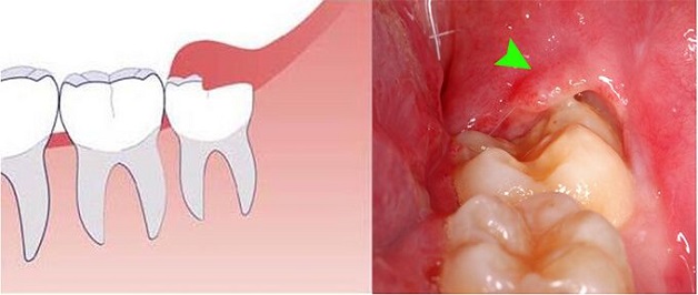 Bệnh viêm lợi trùm: Nguyên nhân và cách điều trị 