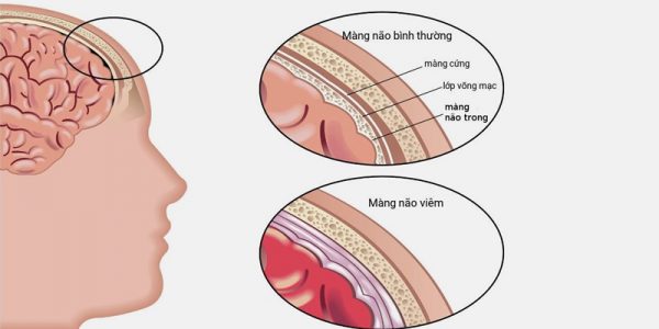 Bệnh viêm màng não ở trẻ sơ sinh có lây không?