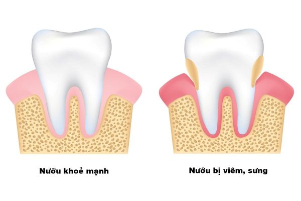 Bệnh viêm nướu và những điều bạn cần biết!