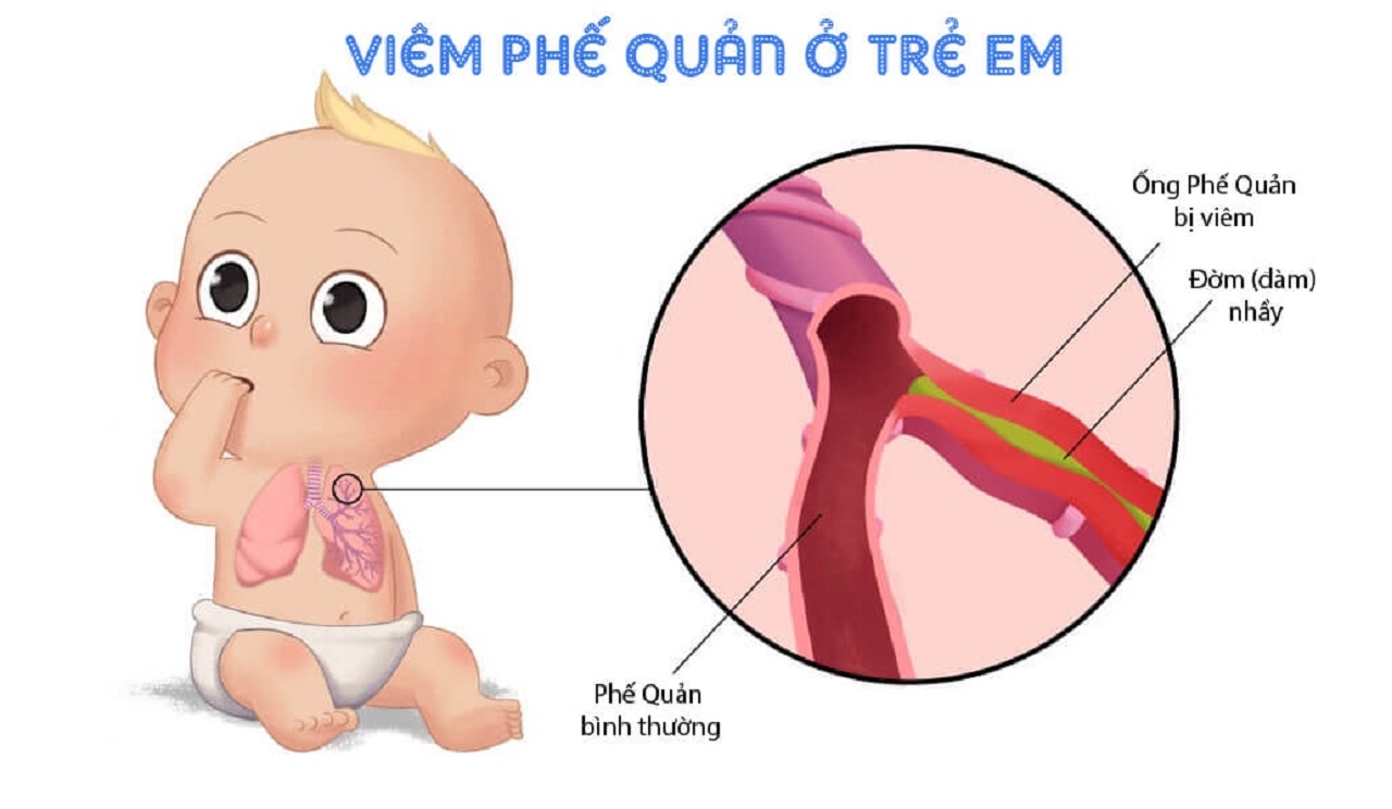 Bệnh viêm phế quản ở trẻ em và cách điều trị đúng nhất