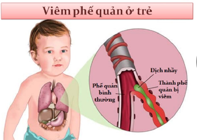 Bệnh viêm phế quản ở trẻ em và cách điều trị đúng nhất