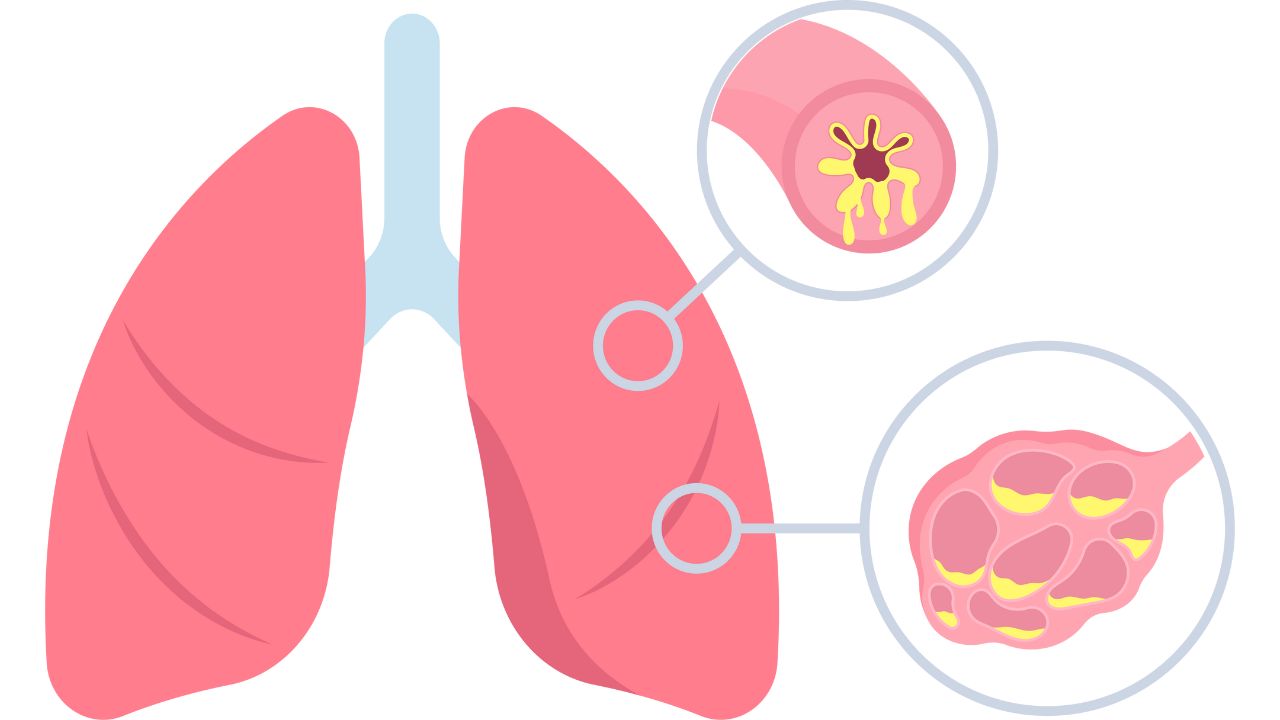 Bệnh viêm phế quản phổi ở trẻ em: Hướng dẫn nhận biết, điều trị