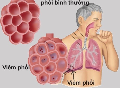 Bệnh viêm phổi cấp tính không được phát hiện