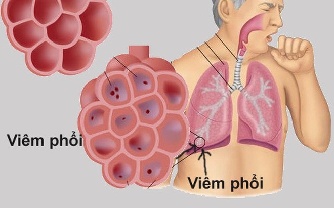 Bệnh viêm phổi nguy hiểm như thế nào?